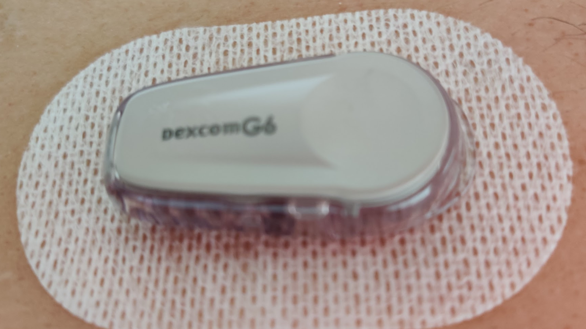 Personal experience of the Dexcom G6 Experience after using it 1 month